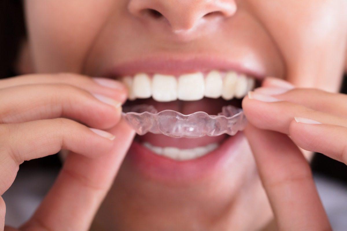 Ortodonzia invisibile, il metodo comodo ed efficace per un sorriso perfetto
